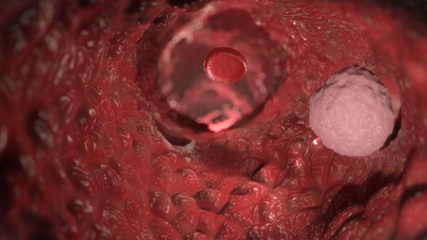 Watch how cancer spreads through the body