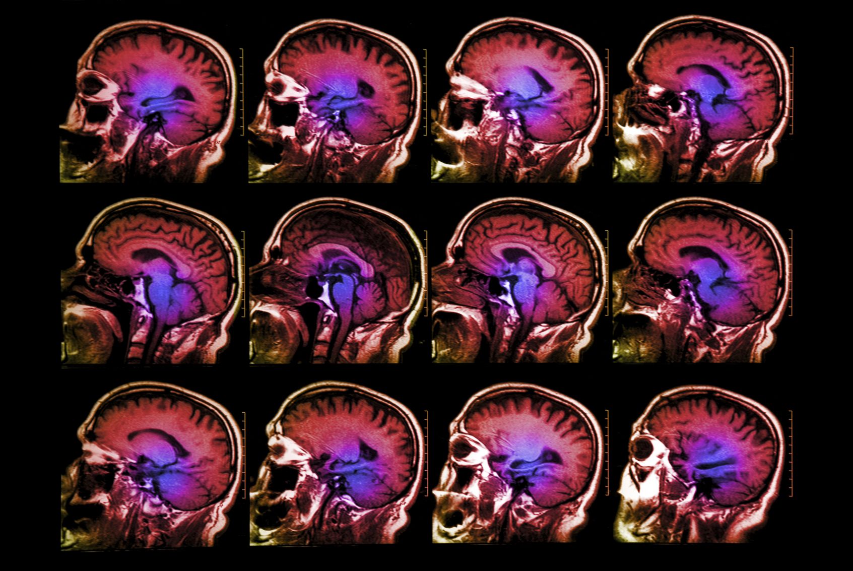 Bug in fMRI software calls 15 years of research into question